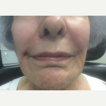 75 and up year old woman treated with Juvederm after 3175238