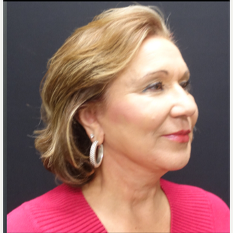 65-74 year old woman treated with Lower Face Lift after 3244901