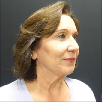 65-74 year old woman treated with Lower Face Lift before 3244901