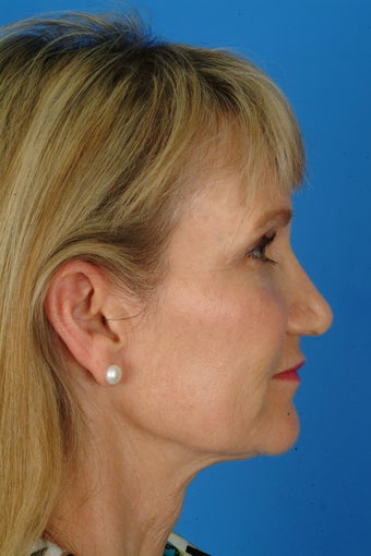 Patient interested in improving her neck, jawline and brow. after 922900