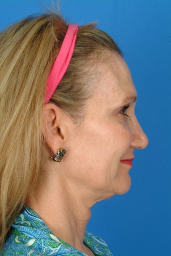 Patient interested in improving her neck, jawline and brow. before 922900