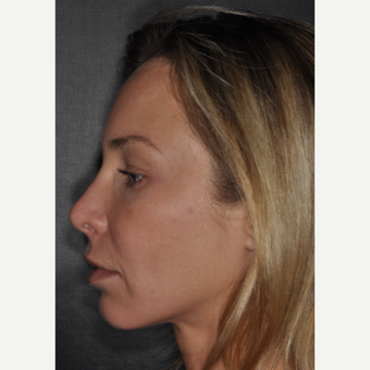 35-44 year old woman treated with Revision Rhinoplasty 2 weeks post-op before 3452242