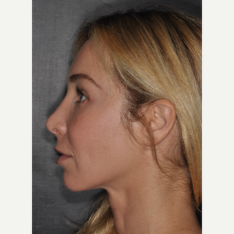 35-44 year old woman treated with Revision Rhinoplasty 2 weeks post-op after 3452242