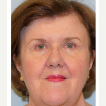 55-64 year old woman treated with Eyelid Surgery after 3678725