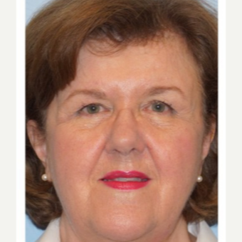 55-64 year old woman treated with Eyelid Surgery before 3678725