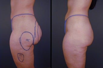 Pure Tumescent Liposuction before 996376