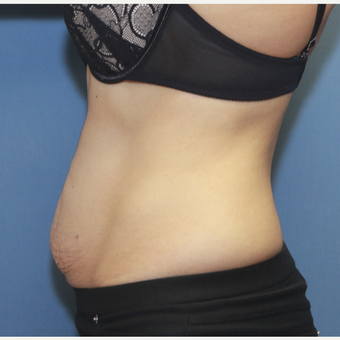 35-44 year old woman treated with Tummy Tuck before 3524587