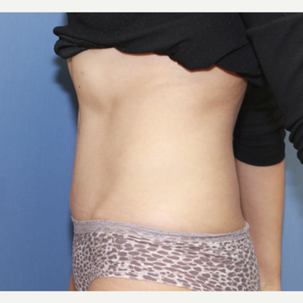 35-44 year old woman treated with Tummy Tuck after 3524587