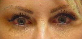 Juvederm injection in the tear troughs after 251714