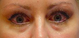 Juvederm injection in the tear troughs before 251714