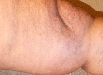 65-74 year old woman treated with Sclerotherapy 3488172