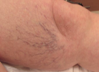 65-74 year old woman treated with Sclerotherapy 3488172
