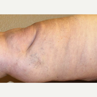 65-74 year old woman treated with Sclerotherapy after 3488172