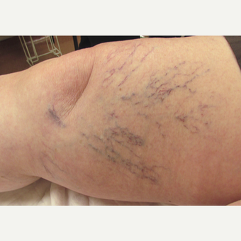 65-74 year old woman treated with Sclerotherapy before 3488172