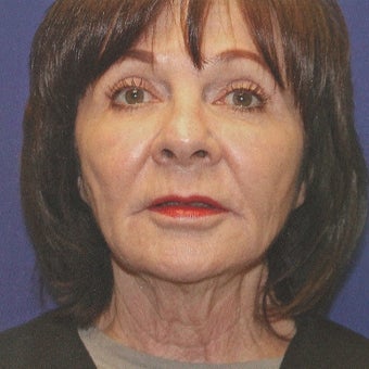 Liquid Facelift And Neck Bands With Juvederm Voluma And Botox before 2047318