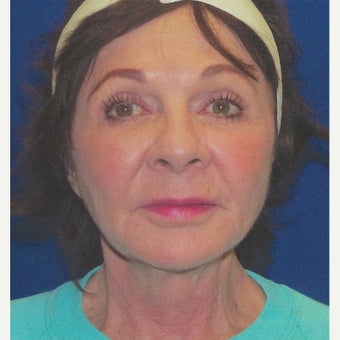 Liquid Facelift And Neck Bands With Juvederm Voluma And Botox after 2047318