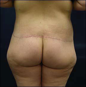 Butt Lift after 94592