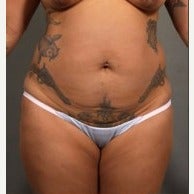 33 year old woman treated with Liposuction before 2361182