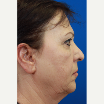 55-64 year old woman treated with Rhinoplasty and septoplasty before 3215106