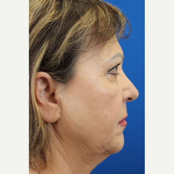 55-64 year old woman treated with Rhinoplasty and septoplasty after 3215106