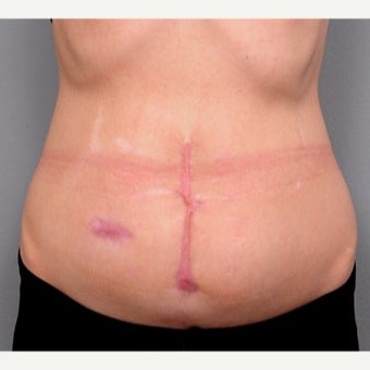 Abdominal Scar Revision & Belly Button Reconstruction before 1697990