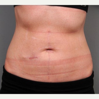 Abdominal Scar Revision & Belly Button Reconstruction after 1697990