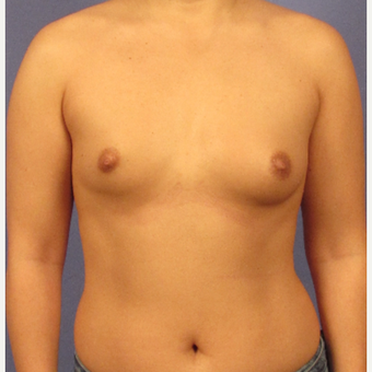 25-34 year old man treated with Breast Augmentation before 3095775