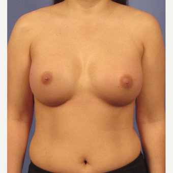 25-34 year old man treated with Breast Augmentation after 3095775