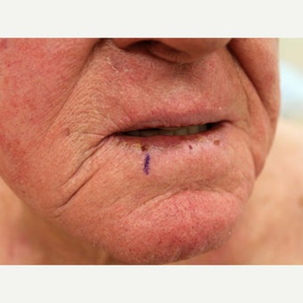 Lip Cancer Treated with Erbium Laser before 2010526