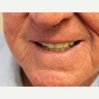 Lip Cancer Treated with Erbium Laser after 2010526