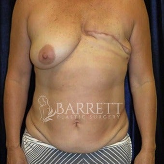 45-54 year old woman treated with Breast Reconstruction before 1983053
