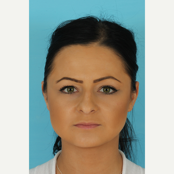 25-34 year old woman treated with Rhinoplasty before 3691262