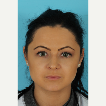 25-34 year old woman treated with Rhinoplasty after 3691262