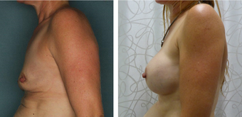 45-54 year old woman treated with Breast Augmentation before 3052712