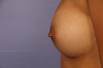 Inverted Nipple Repair after 692987