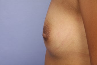 Inverted Nipple Repair before 692987