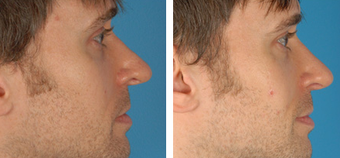 Revision Rhinoplasty before 1208290