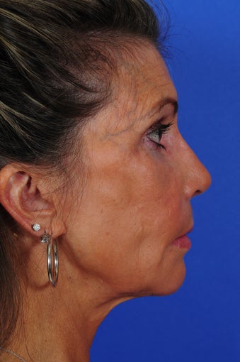 Revision Rhinoplasty 322728
