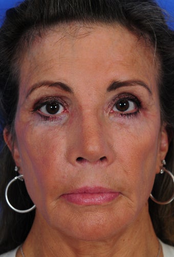 Revision Rhinoplasty after 322728