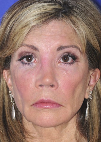 Revision Rhinoplasty before 322728