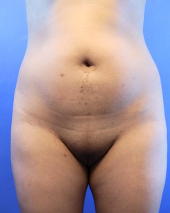26 Year Old Woman Had Laser Liposuction before 1166594