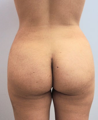 26 Year Old Woman Had Laser Liposuction 1166594