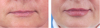 Lip Augmentation before 253984