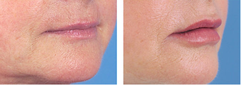 Lip Augmentation after 253984