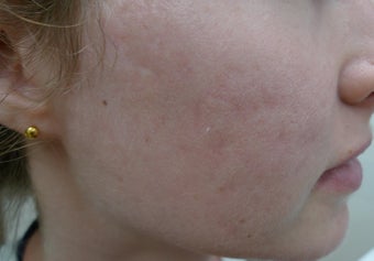 Filling scars in 5 minutes after 1423046