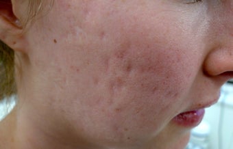 Filling scars in 5 minutes before 1423046