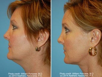 Neck Liposuction before 212293