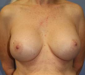 Breast Augmentation, 425cc silicone implants 1335859