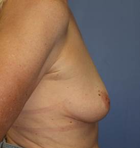 Breast Augmentation, 425cc silicone implants before 1335859