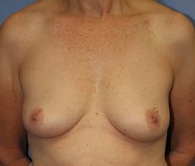 Breast Augmentation, 425cc silicone implants 1335859